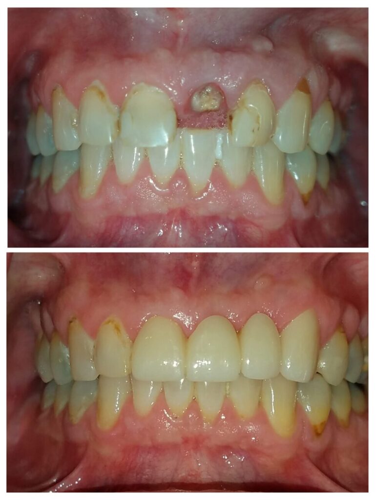 Dental Bridge in Towson, MD