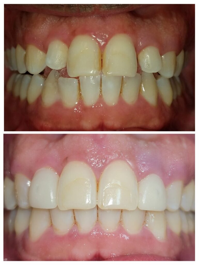 pt had crooked lateral that were undersized and had spacing issues. The patient went through clear braces, Bleaching, and than bonding on lateral incisors to make the shape more pleasing